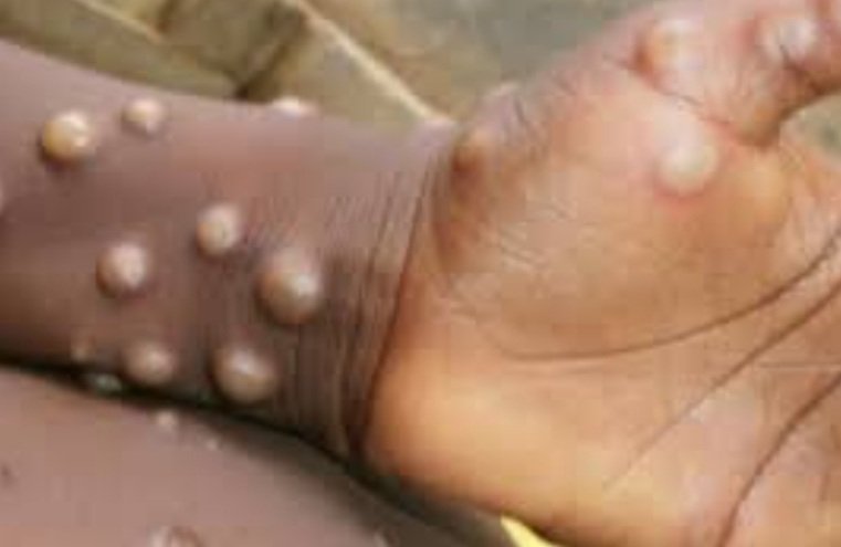 ମଙ୍କି ଫକ୍ସ ମୁକାବିଲା ନେଇ ଏହା କହିଲେ ସ୍ଵାସ୍ଥ୍ୟ ନିର୍ଦ୍ଦେଶକ