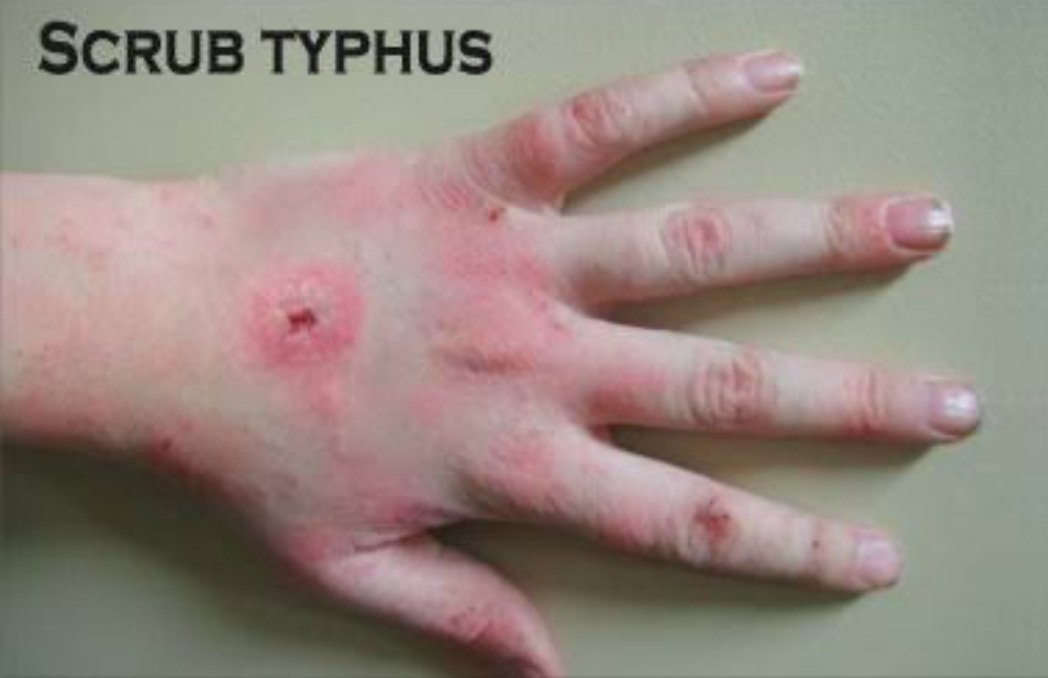 ନୂଆ ରୋଗ ଆତଙ୍କ, ସ୍କ୍ରବ ଟାଇଫସରେ ୩ ଆକ୍ରାନ୍ତ ଚିହ୍ନଟ