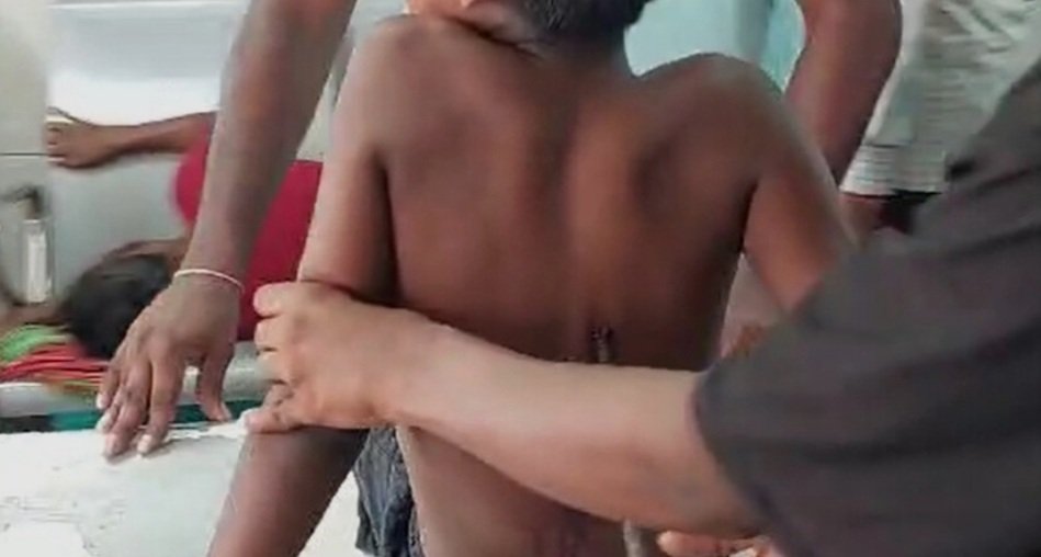 ଶିଶୁ ଦେହରେ ପଶିଗଲା ଲୁହା ଛଡ଼