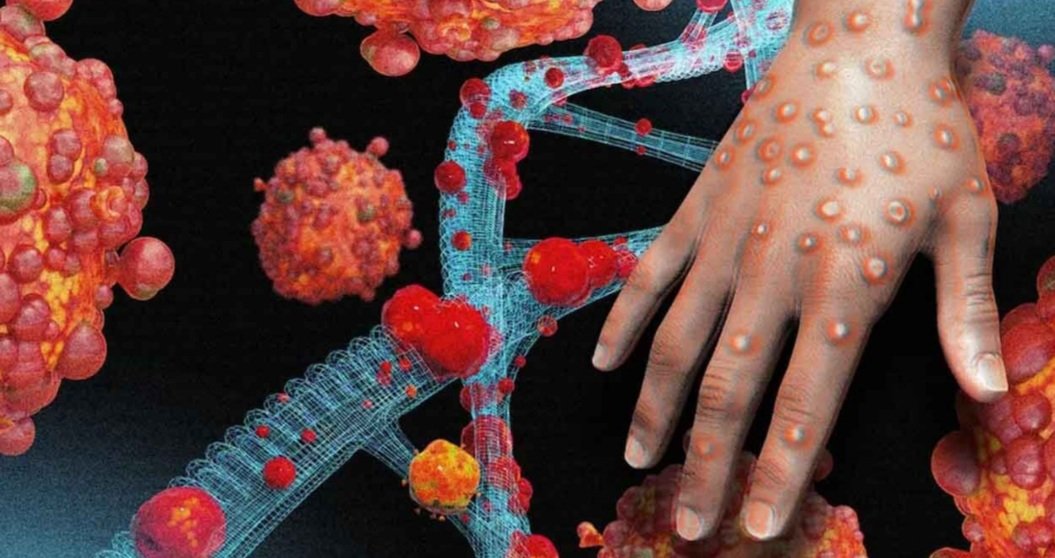 ମଙ୍କି ପକ୍ସ ପାଇଁ ସ୍ୱାସ୍ଥ୍ୟ ବିଭାଗର ଆଗୁଆ ପ୍ରସ୍ତୁତି, ସବୁ ସିଡିଏମ୍ଓଙ୍କୁ ଚିଠି