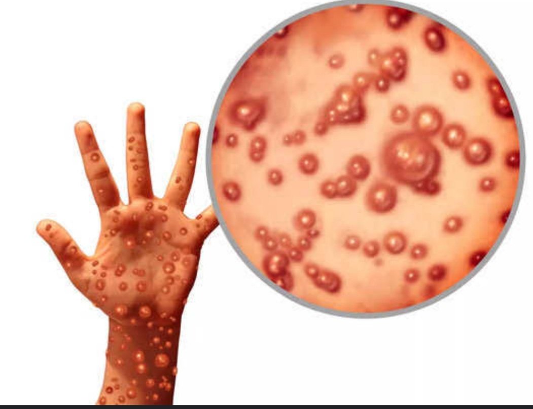 ମଙ୍କିପକ୍ସକୁ ନେଇ ସ୍ୱାସ୍ଥ୍ୟବିଭାଗ ସମ୍ପୂର୍ଣ୍ଣ ସଜାଗ: ବିଜୟ ମହାପାତ୍ର 