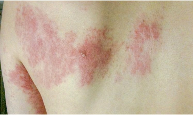 ଏମିତି କରି ଶରୀରରୁ ଲିଭାନ୍ତୁ ପୋଡା ଚିହ୍ନ ଓ ଦାଗ