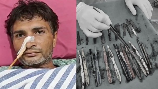 ପେଟରୁ ୨୯ ଚାମଚ ବାହାରିଲା ଚାମଚ ଓ ଟୁଥ୍‌ବ୍ରଶ