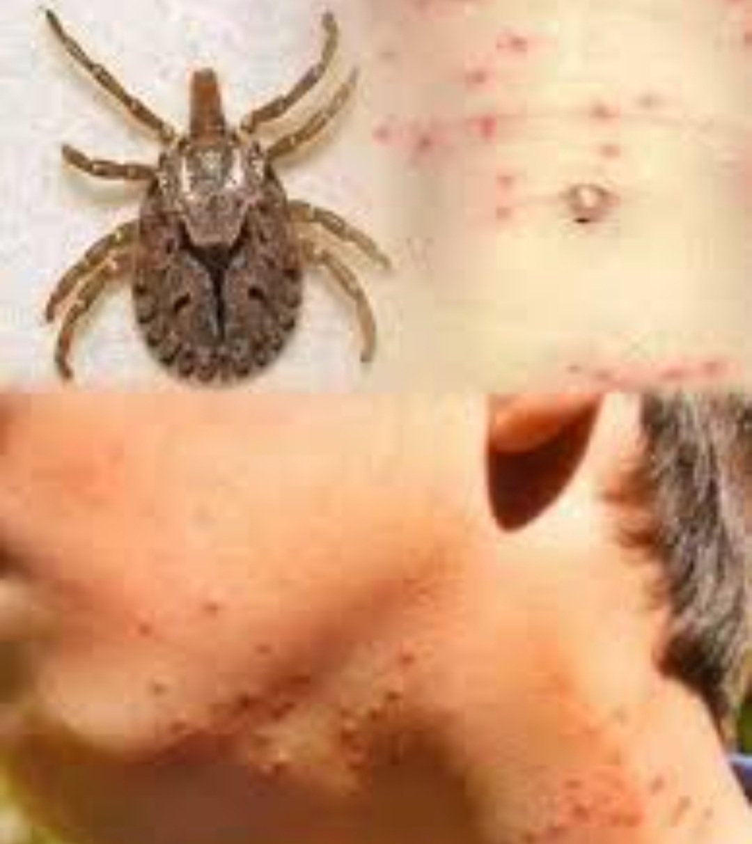 ସୁନ୍ଦରଗଡ଼ରେ  ଚିନ୍ତା ବଢ଼ାଇଛି ସ୍କ୍ରବ୍‌ ଟାଇଫସ