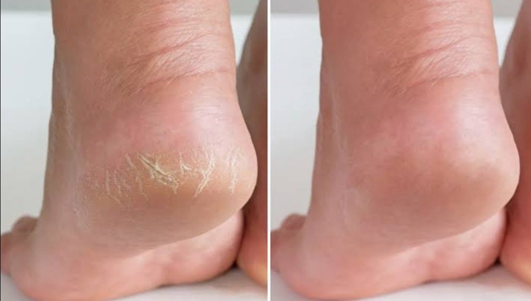 ଶୀତଦିନେ ଗୋଇଠି ଫାଟୁଥିଲେ କରନ୍ତୁ ଏହି ଉପାୟ 