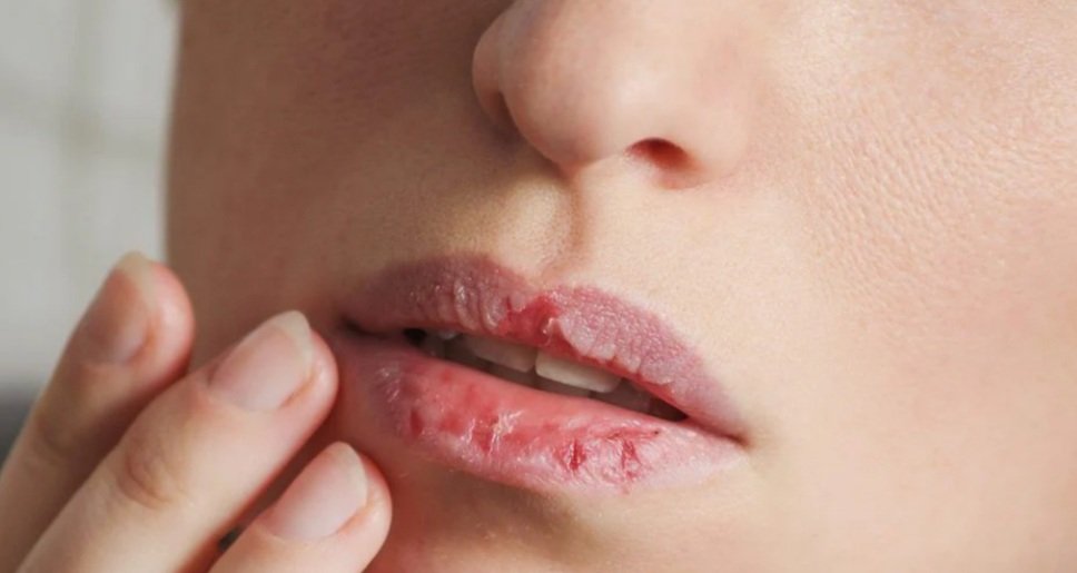 ଶୀତଦିନେ ଓଠର ଫାଟିବାର କାରଣ ଓ ନିରାକରଣ ଜାଣନ୍ତୁ.....