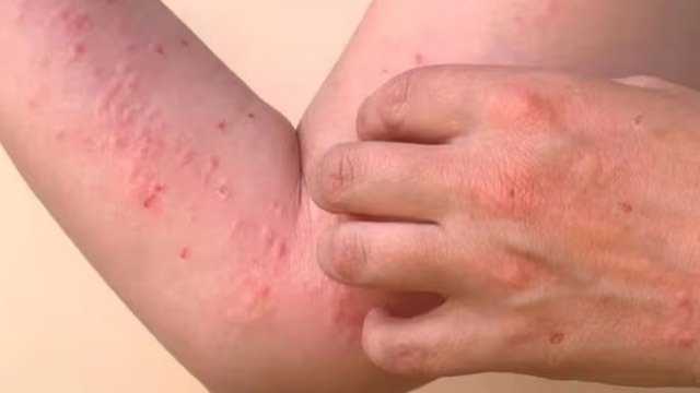 ବାଂଲାଦେଶରେ ମିଳିମିଳା ମହାମାରୀ  !୨୫୦ ଜଣଙ୍କ ମୃତ୍ୟୁ